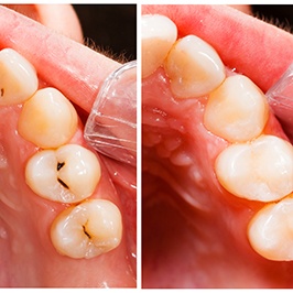 before and after closeups for fillings