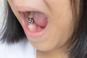 little girl opening her mouth and showing a dental crown